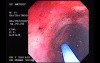 Radiation Proctosigmoiditis (6 of 14)