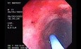 Radiation Proctosigmoiditis (6 of 14)
