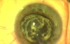 Fugo Plasma Blade Ablation Capsulotomy - Nanotechnology in Cataract Surgery
