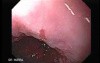 Barrett's Esophagus of long segment (11 of 11)