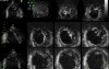 Left Ventricular Noncompaction in 3D Echocardiography, Video nr 2