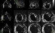 Left Ventricular Noncompaction in 3D Echocardiography, Video nr 2