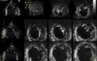 Left Ventricular Noncompaction in 3D Echocardiography, Video nr 2