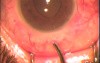 Fugo Blade Used In Glaucoma Surgery