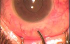 Fugo Blade Used In Glaucoma Surgery