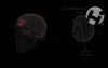 Summary of Brain Injuries