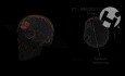 Summary of Brain Injuries