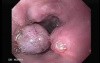 Severe Bleeding of the Upper Digestive System After Two Days of Band Ligation - Varices Post Ligation