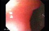 Reflux Esophagitis and Adenocarcinoma of the Antrum (3 of 3)