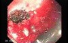 Tubulo - Villous Rectal Adenoma - Endoscopy (16 of 35)