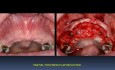 Maxillary Anterior Teeth Replacement With Implant Crowns