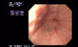 Reflux Esophagitis - Radial Ulcers