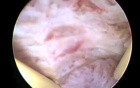 Histeroscopic endometrial ablation