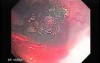 Tubulo - Villous Rectal Adenoma - Endoscopy (11 of 35)