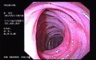 Diverticular Disease - Hemorrhage (14 of 15)