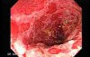 Colonic Lymphoma (6 of 6)