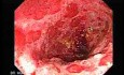 Colonic Lymphoma (6 of 6)