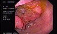 Adenoarcinoma Of The Ascending Colon (1 of 3)
