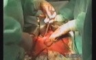 Gastric Cancer Surgery - Stomach Stump Extirpation