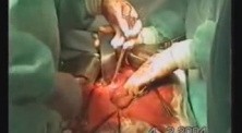 Gastric Cancer Surgery - Stomach Stump Extirpation