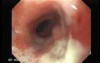 Esophagus - Pneumatic Dilation for Achalasia - Follow Up a Year After Procedure