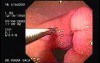 Gastric Submucosal Nodules (2 of 3)