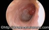 Attic Polyp