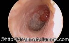 Attic Polyp