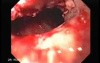 Synchronous Cancer Gastric and Esophageal (6 of 9 )