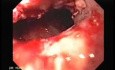 Synchronous Cancer Gastric and Esophageal (6 of 9 )