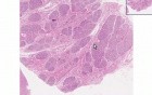 Hyperplasia of pregnancy - Histopathology - Breast 