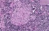 Sarcoidosis