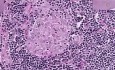 Sarcoidosis