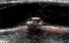 Motion Analysis of the CCA 