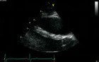 Echocardiography - Parasternal View -  Normal Study