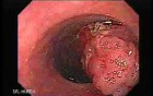 Large Tubulo-Villous Adenoma (1 of 6)