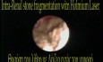RIRS + Laser Stone Fragmenation