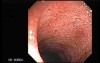 Ulcerative Colitis Complicating Pseudomembranous Colitis (1 of 4)