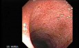 Ulcerative Colitis Complicating Pseudomembranous Colitis (1 of 4)