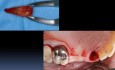 Ridge Augmentation 101 