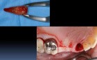 Ridge Augmentation 101 
