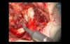 Canal – Wall – Down Retympanoplasty With SC (Short Columella) Ossiculoplasty 