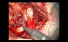 Canal – Wall – Down Retympanoplasty With SC (Short Columella) Ossiculoplasty 