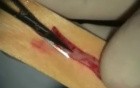 Connective Tissue Grafting 