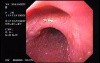 Esophageal Mucosal Bridge - Esophageal Diverticulum