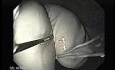 Achalasia - Guidewire For Esophageal Dilation - 1/4