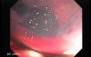 Endoscopic Resection of Giant Tubulo-Villous of the rectum (11 of 35)