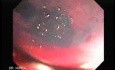 Endoscopic Resection of Giant Tubulo-Villous of the rectum (11 of 35)