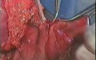 Gastric Cancer Surgery - Subtotal Gastrectomy