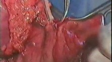 Gastric Cancer Surgery - Subtotal Gastrectomy